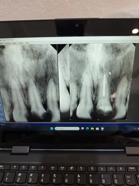 Laptop screen showing dental X-rays before and after a root canal treatment